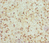Immunohistochemistry of paraffin-embedded human glioma using CSB-PA015660DSR1HU at dilution of 1:100