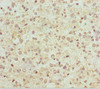 Immunohistochemistry of paraffin-embedded human glioma using CSB-PA015660DSR2HU at dilution of 1:100
