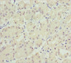 Immunohistochemistry of paraffin-embedded human gastric cancer using CSB-PA801219ESR2HU at dilution of 1:100