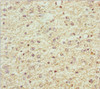 Immunohistochemistry of paraffin-embedded human glioma using CSB-PA856936ESR2HU at dilution of 1:100