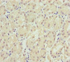 Immunohistochemistry of paraffin-embedded human gastric cancer using CSB-PA022583ESR1HU at dilution of 1:100