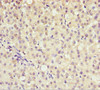 Immunohistochemistry of paraffin-embedded human liver cancer using CSB-PA001550ESR1HU at dilution of 1:100