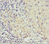 Immunohistochemistry of paraffin-embedded human liver cancer using CSB-PA001550ESR2HU at dilution of 1:100