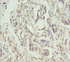 Immunohistochemistry of paraffin-embedded human pancreatic cancer using CSB-PA618641DSR1HU at dilution of 1:100