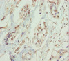 Immunohistochemistry of paraffin-embedded human pancreatic cancer using CSB-PA618641DSR2HU at dilution of 1:100