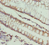 Immunohistochemistry of paraffin-embedded human colon cancer using CSB-PA889142DSR2HU at dilution of 1:100