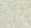 Immunohistochemistry of paraffin-embedded human glioma using CSB-PA897463ESR2HU at dilution of 1:100