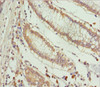 Immunohistochemistry of paraffin-embedded human colon cancer using CSB-PA007791ESR1HU at dilution of 1:100