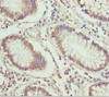 Immunohistochemistry of paraffin-embedded human colon cancer using CSB-PA007844ESR1HU at dilution of 1:100