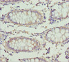Immunohistochemistry of paraffin-embedded human colon cancer using CSB-PA007844ESR2HU at dilution of 1:100