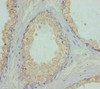 Immunohistochemistry of paraffin-embedded human prostate cancer using CSB-PA667562ESR1HU at dilution of 1:100
