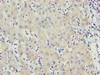 Immunohistochemistry of paraffin-embedded human liver cancer using CSB-PA867199ESR1HU at dilution of 1:100