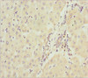 Immunohistochemistry of paraffin-embedded human liver cancer using CSB-PA624119ESR1HU at dilution of 1:100