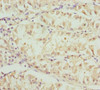 Immunohistochemistry of paraffin-embedded human gastric cancer using CSB-PA880985ESR2HU at dilution of 1:100