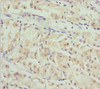 Immunohistochemistry of paraffin-embedded human gastric cancer using CSB-PA890765ESR1HU at dilution of 1:100