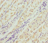 Immunohistochemistry of paraffin-embedded human gastric cancer using CSB-PA890765ESR2HU at dilution of 1:100