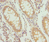 Immunohistochemistry of paraffin-embedded human colon cancer using CSB-PA864016DSR1HU at dilution of 1:100