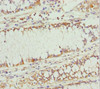 Immunohistochemistry of paraffin-embedded human colon cancer using CSB-PA864016DSR2HU at dilution of 1:100