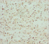 Immunohistochemistry of paraffin-embedded human glioma using CSB-PA621768ESR1HU at dilution of 1:100