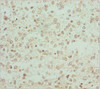 Immunohistochemistry of paraffin-embedded human glioma using CSB-PA621768ESR1HU at dilution of 1:100