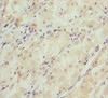 Immunohistochemistry of paraffin-embedded human gastric cancer using CSB-PA021874ESR1HU at dilution of 1:100
