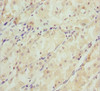 Immunohistochemistry of paraffin-embedded human gastric cancer using CSB-PA021874ESR1HU at dilution of 1:100