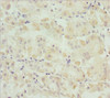 Immunohistochemistry of paraffin-embedded human gastric cancer using CSB-PA021874ESR2HU at dilution of 1:100