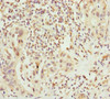 Immunohistochemistry of paraffin-embedded human bladder cancer using CSB-PA892453ESR2HU at dilution of 1:100