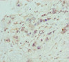 Immunohistochemistry of paraffin-embedded human pancreatic cancer using CSB-PA890771ESR1HU at dilution of 1:100