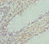 Immunohistochemistry of paraffin-embedded human colon cancer using CSB-PA890771ESR2HU at dilution of 1:100