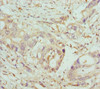 Immunohistochemistry of paraffin-embedded human pancreatic cancer using CSB-PA890771ESR2HU at dilution of 1:100