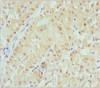 Immunohistochemistry of paraffin-embedded human gastric cancer using CSB-PA006025ESR1HU at dilution of 1:100