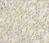 Immunohistochemistry of paraffin-embedded human gastric cancer using CSB-PA708490ESR1HU at dilution of 1:100