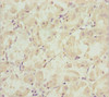 Immunohistochemistry of paraffin-embedded human gastric cancer using CSB-PA708490ESR2HU at dilution of 1:100