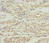 Immunohistochemistry of paraffin-embedded human gastric cancer using CSB-PA859028ESR1HU at dilution of 1:100