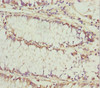 Immunohistochemistry of paraffin-embedded human colon cancer using CSB-PA012149ESR1HU at dilution of 1:100