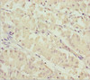 Immunohistochemistry of paraffin-embedded human gastric cancer using CSB-PA022393ESR1HU at dilution of 1:100