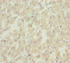 Immunohistochemistry of paraffin-embedded human gastric cancer using CSB-PA022393ESR2HU at dilution of 1:100