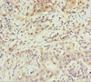 Immunohistochemistry of paraffin-embedded human bladder cancer using CSB-PA868325ESR1HU at dilution of 1:100