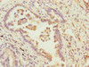 Immunohistochemistry of paraffin-embedded human lung cancer using CSB-PA861077ESR1HU at dilution of 1:100