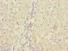 Immunohistochemistry of paraffin-embedded human liver cancer using CSB-PA850803ESR1HU at dilution of 1:100