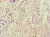 Immunohistochemistry of paraffin-embedded human bladder cancer using CSB-PA822217ESR2HU at dilution of 1:100