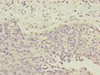 Immunohistochemistry of paraffin-embedded human cervical cancer using CSB-PA889176DSR2HU at dilution of 1:100