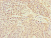 Immunohistochemistry of paraffin-embedded human ovarian cancer using CSB-PA005266DSR1HU at dilution of 1:100
