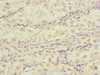 Immunohistochemistry of paraffin-embedded human gastric cancer using CSB-PA006569ESR1HU at dilution of 1:100