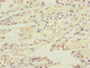 Immunohistochemistry of paraffin-embedded human gastric cancer using CSB-PA006569ESR2HU at dilution of 1:100