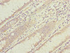 Immunohistochemistry of paraffin-embedded human colon cancer using CSB-PA007293ESR1HU at dilution of 1:100