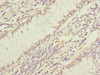 Immunohistochemistry of paraffin-embedded human colon cancer using CSB-PA007293ESR2HU at dilution of 1:100