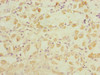 Immunohistochemistry of paraffin-embedded human gastric cancer using CSB-PA007293ESR2HU at dilution of 1:100