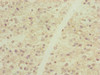 Immunohistochemistry of paraffin-embedded human glioma using CSB-PA844722ESR2HU at dilution of 1:100